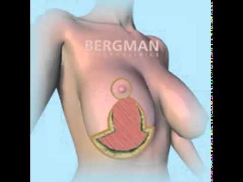 Breast Reduction Anchor method at Bergman Clinics | Bergman Kliniek