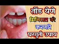       tond yene gharguti upay in marathi mouth ulcer home remedy