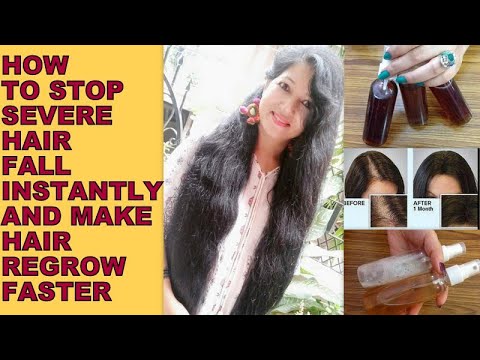 3-best-remedies-to-stop-severe-hairfall,-alopecia,-and-grow-hair-faster-|-बालों-का-झड़ना-कैसे-रोकें