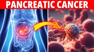 Top 5 Pancreatic Cancer Risk Factors Everyone Should Know by The Daily Topic 133 views 11 months ago 8 minutes, 15 seconds