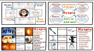 Myopia  Full Tutorial (Introduction, Classification, Clinical Features and Management