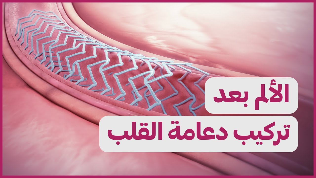 Pain after stent الألم بعد تركيب دعامة القلب YouTube