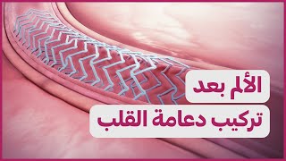 Pain after stent | الألم بعد تركيب دعامة القلب