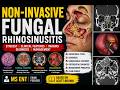 Non-Invasive Fungal Rhinosinusitis | Etiology, Clinical Features, Imaging & Management | MS ENT