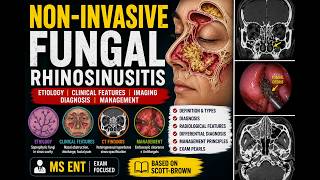 Non-Invasive Fungal Rhinosinusitis | Etiology, Clinical Features, Imaging &amp; Management | MS ENT