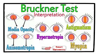 Interpretation of Bruckner Test
