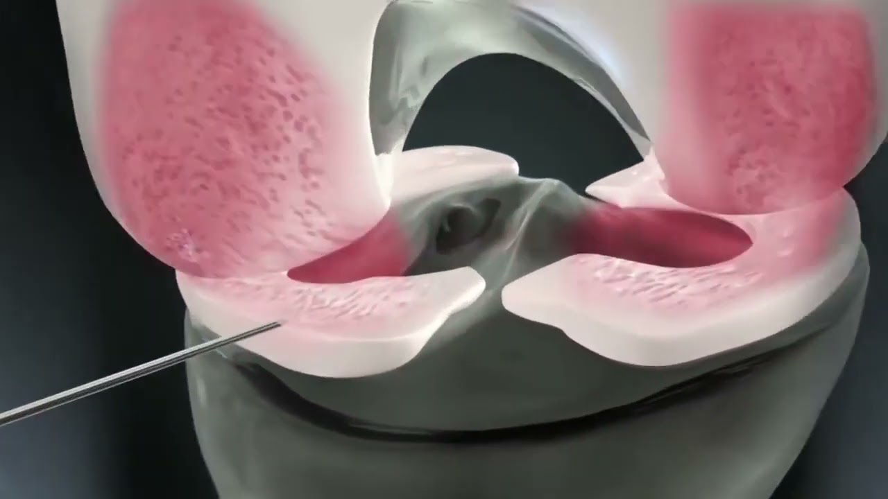 MONOVISC® - Innovative Einzelinjektionstherapie zur Behandlung von Arthrose-Schmerzen