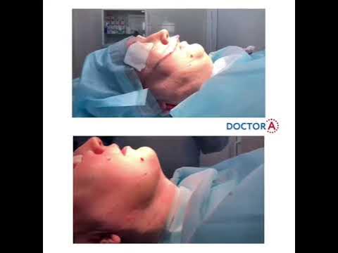 Липосакция подбородка до и после - YouTube