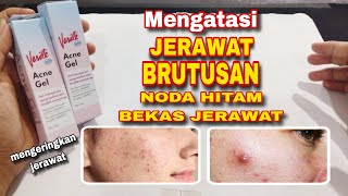 Obat Ampuh Untuk Menghilangkan Jerawat Batu dan Flek Hitam Bekas Jerawat diapotik | Verile Acne Gel