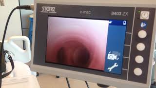 Endotracheal tube position check using a bronchoscope