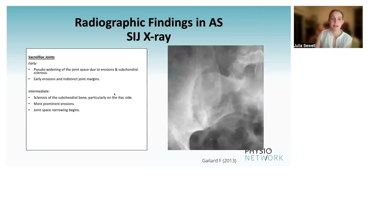 Interpreting Radiographs for Ankylosing Spondylitis | Dr Julia Sewell | Spondyloathropathy Playbook