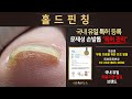 [특허관리] 한쪽이 말려들어간 발톱 2차 관리 / What will this toenail look like a month later?