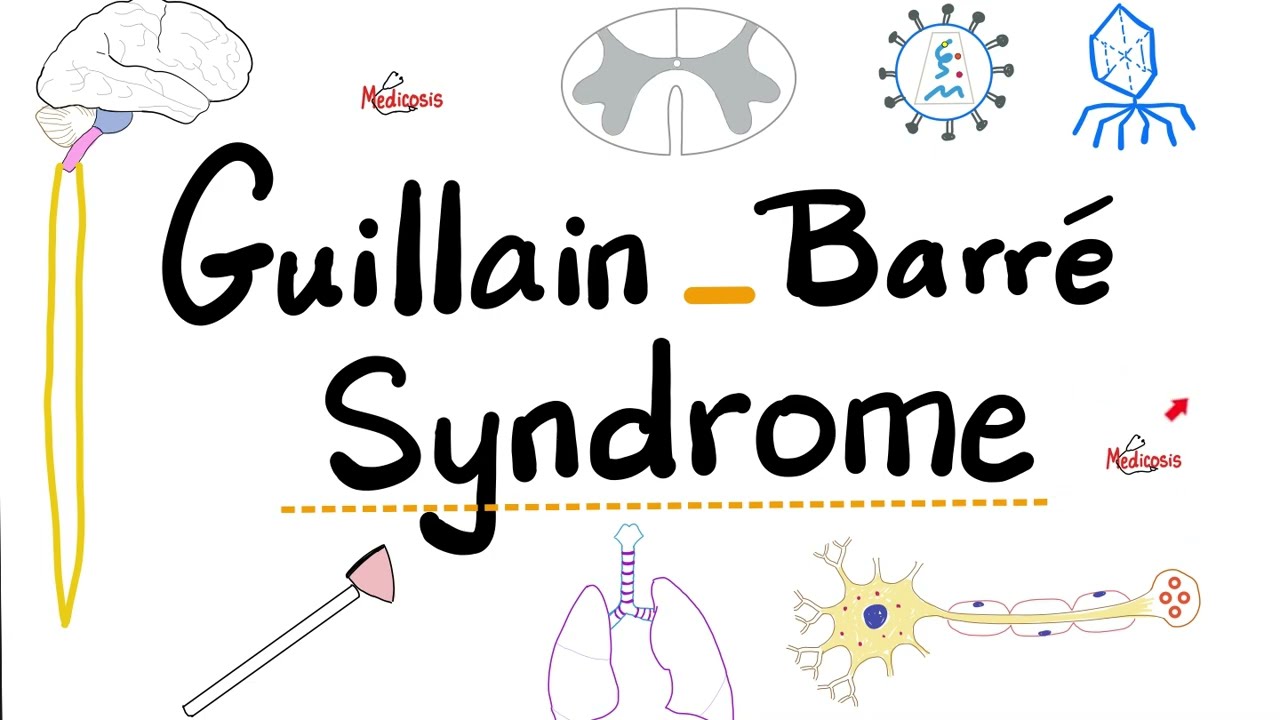 Guillain-Barré Syndrome - Acute Inflammatory Demyelinating Polyradiculoneuropathy “AIDP”- Neurology