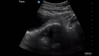 Pelvic Ultrasound for Ectopic Pregnancy: The Critical Findings You Must Catch
