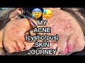 MY ACNE SKIN JOURNEY 😖😢| Cystic PCOS acne |