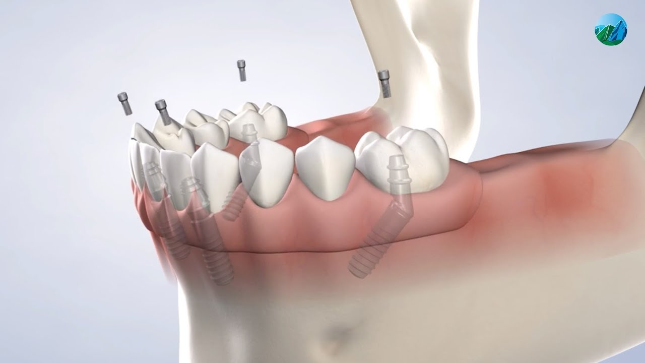 Full-Arch Restoration at Boulder Oral Surgery & Dental Implants, Boulder, CO
