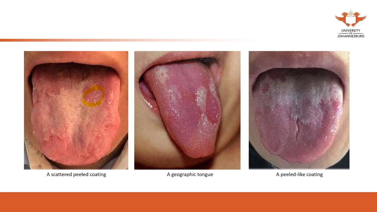 193-uj-online-lectures-32-diagnostics-tongue-diagnosis-tongue-coating