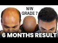 Grade 7 hair transplant result india  6000 grafts 