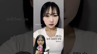 느좋녀&#39;s 눈코얼굴형 성형 후기 #shorts