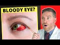 Broken Blood Vessel And Bloodshot Eye?! - Subconjunctival Hemorrhage (Causes, Treatment)