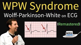 Wolff Parkinson White Syndrome on ECG - WPW Pathophysiology