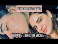 MY PCOS STORY | How I got rid of acne |Q&A PCOS