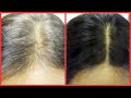 TURN GRAY HAIR BLACK IN 30 MINUTES, NATURAL FAST-ACTING HOMEMADE HAIR DYE, Khichi Beauty