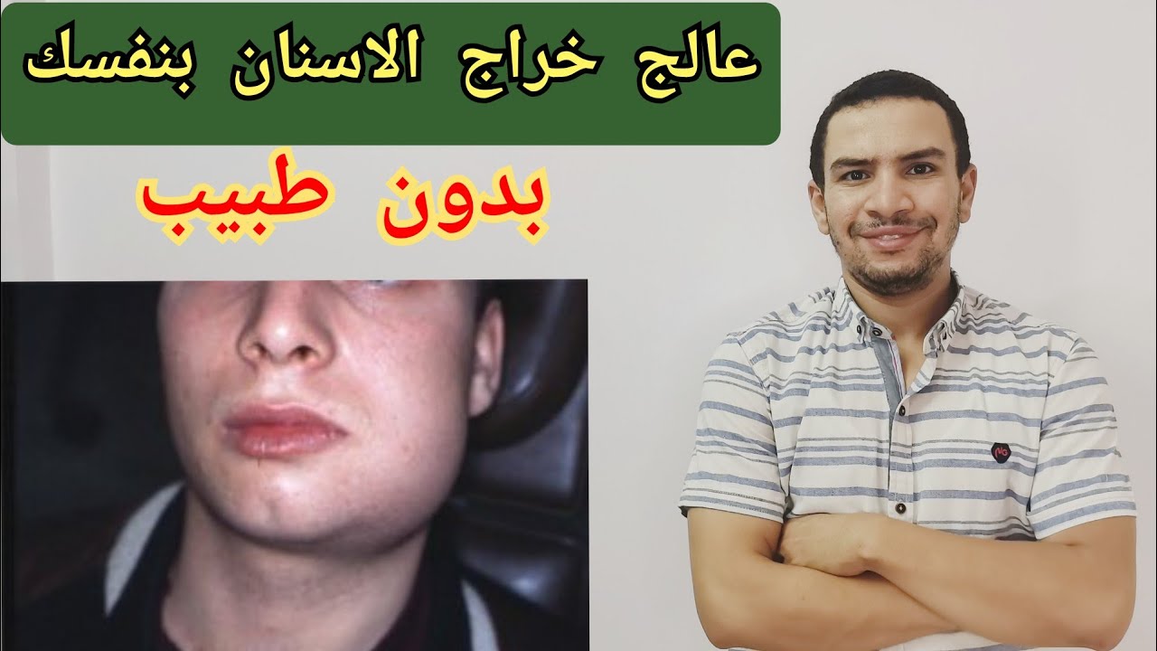 كيف تعالج خراج الاسنان و ورم الوجه بنفسك بخطوات بسيطه