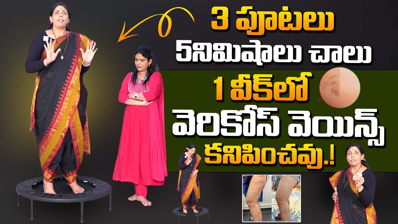 3 పూటలు 5 ని.లు చాలు 1 వీక్ లో వెరికోస్ వెయిన్స్ కనిపించవు.! | Get Rid Varicose Veins | Aruna Yoga
