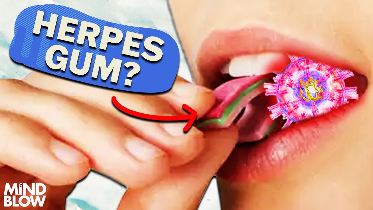 Herpes Gum? - Mind Blow #142
