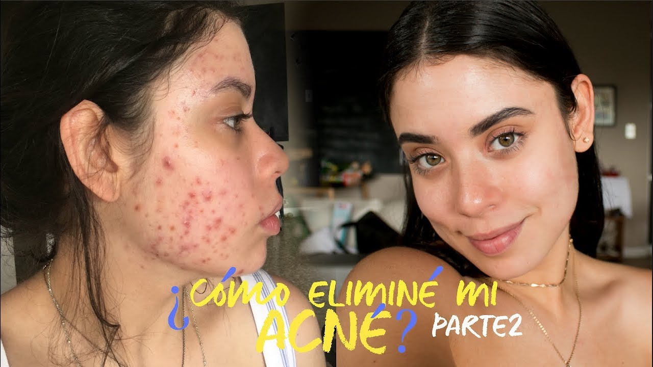 Como eliminar el acne naturalmente