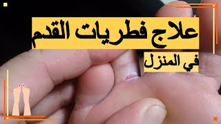 علاج فطريات القدم بالمنزل .. أهم الأعشاب والأدوية للعلاج