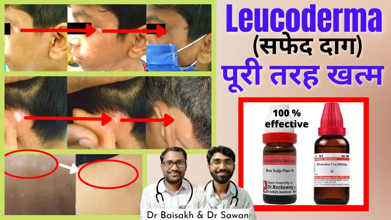 best homeopathic medicine for leucoderma/vitiligo- सफेद दाग की होम्योपैथिक दवा // 100% results
