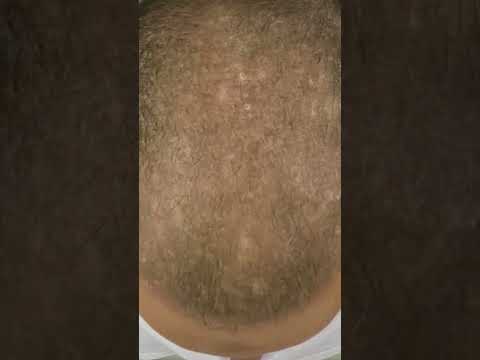 لوشن نيوهير الاصلي علاج الصلع النهائي