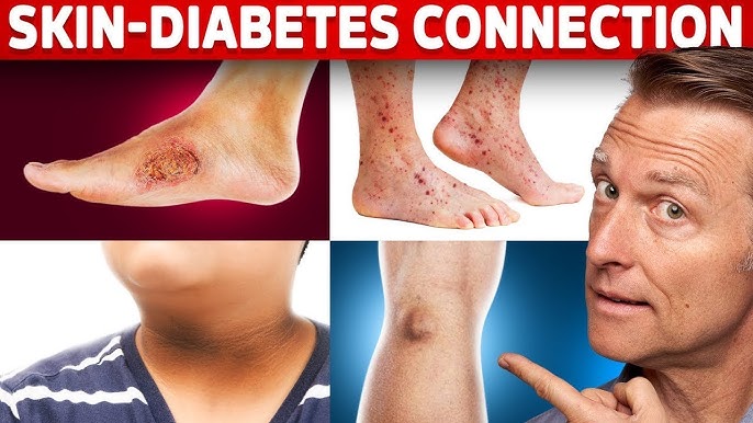 The Connection Between Diabetes And Skin Health