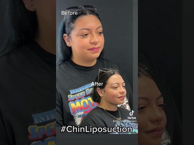 Chin Lipo Transformation