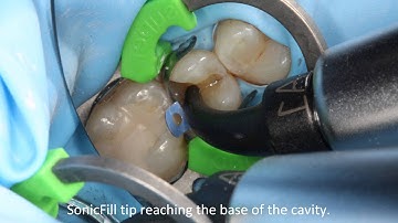Dr Adam Doudney Class II Restoration with Triodent V3 and Kerr SonicFill