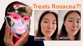 Treating rosacea with an LED light mask?!
