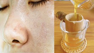 Ayurvedic remedy for open pores | The only remedy that you will ever gonna need for open pores #diy screenshot 5