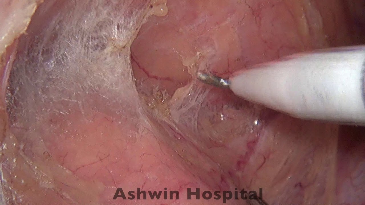 video phone beyonce mp3 Laparoscopic low AR step by step with voice over in male pt