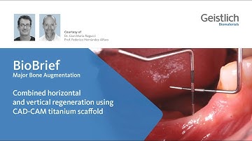 Combined horizontal and vertical regeneration using CAD-CAM titanium scaffold
