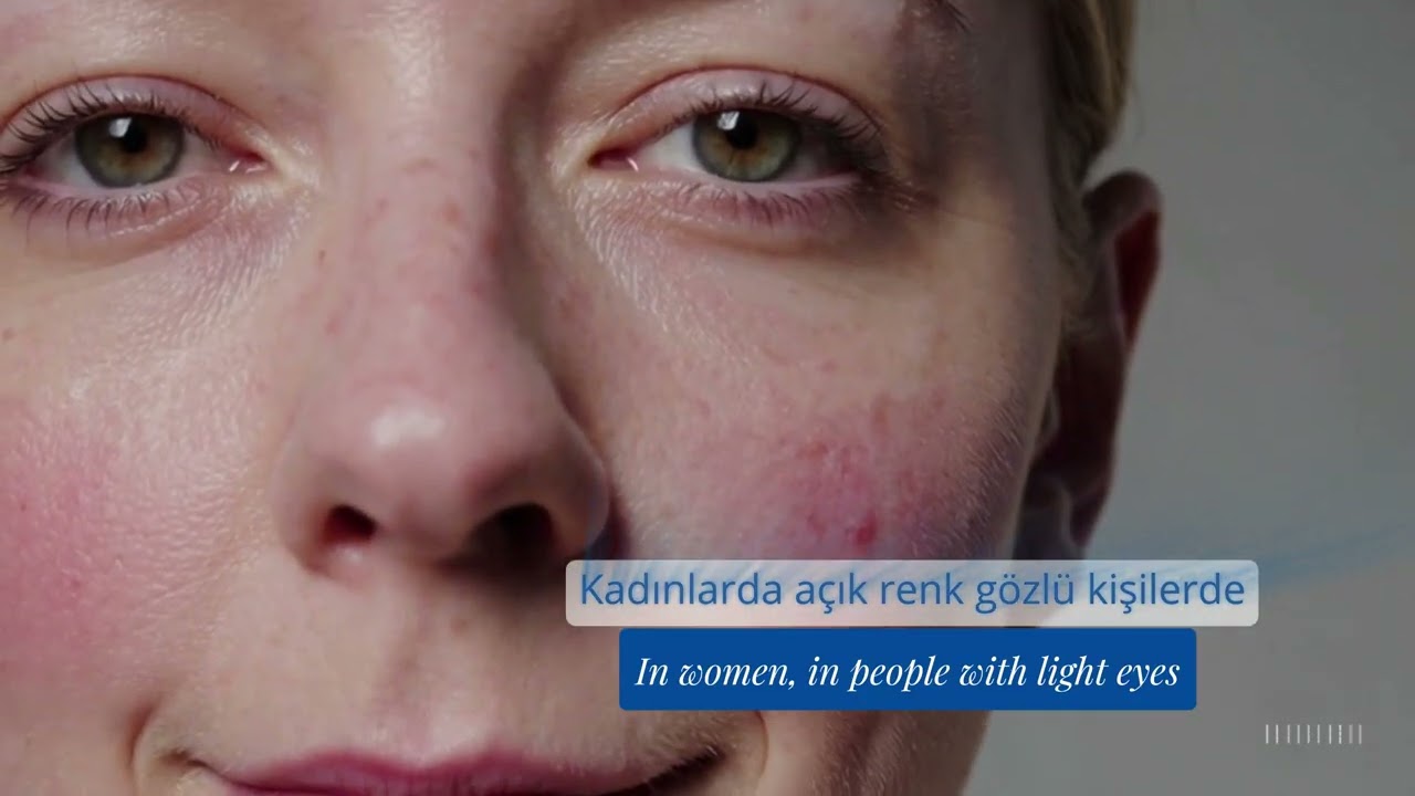 Rozasea (Gül Hastalığı) Nedir? Belirtileri, Nedenleri ve Tedavi Yöntemleri | Dr. Neval Bayazit