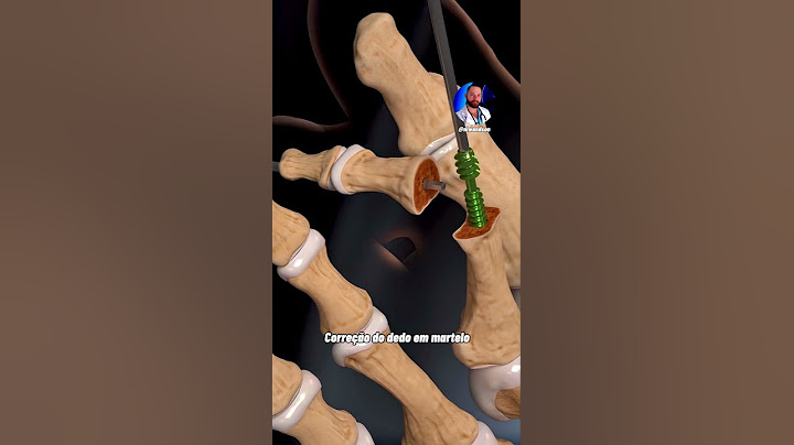 عملية تعديل اصبع القدم