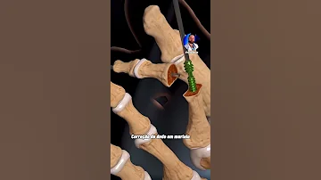 عملية تعديل اصبع القدم 