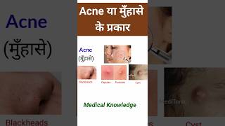 Acne या मुँहासे के प्रकार