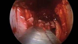 Download Nose Job Hd: The Endoscopic Approach Video MP3 Nose Job Hd: The Endoscopic Approach