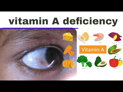 Indhaha Nafaqo Darada Ku Dhaca Xerophthalmia
