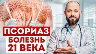 Как вылечить псориаз с помощью ОДНОЙ свечки? / После ЭТОГО ваша кожа будет ЧИСТОЙ и КРАСИВОЙ!