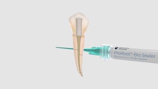 Single Cone Technique with ProRoot® Bio Sealer and Conform Fit® Gutta-Percha Points