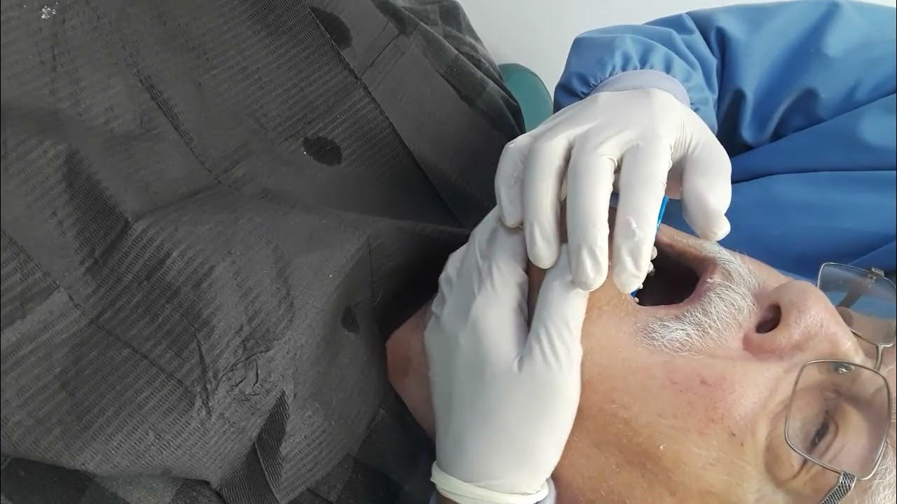 How to take Proper Alginate Impression Part 5 YouTube